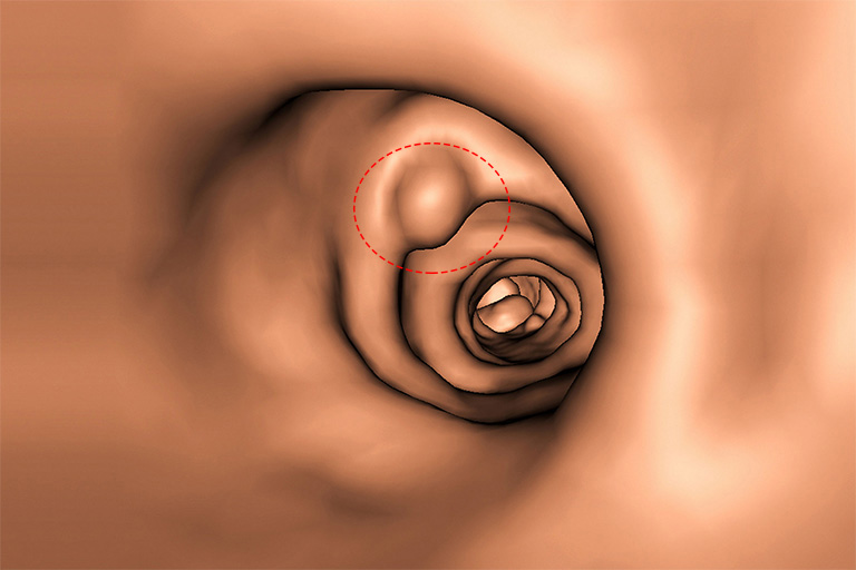 Polyp đại tràng không cuống nằm ngay tại lớp niêm mạc lót trong cơ quan này và có chân rộng