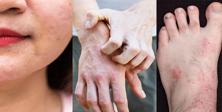 Viêm da là căn bệnh dễ tái phát và khó điều trị dứt điểm hiện nay