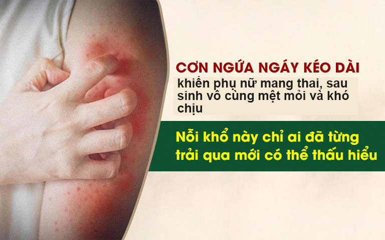 Bệnh viêm da gây nhiều khó chịu và ảnh hưởng đến sinh hoạt, sức khỏe của các mẹ bầu, sau sinh