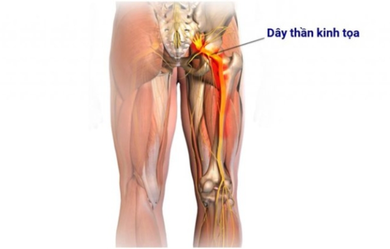 Đau dây thần kinh tọa hình thành nên các cơn đau tại vùng lưng và kéo dài đến chi dưới