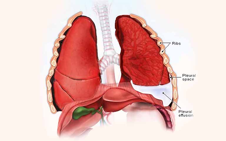 Tràn dịch màng phổi là bệnh lý nguy hiểm cần được điều trị kịp thời để tránh ảnh hưởng đến chức năng phổi
