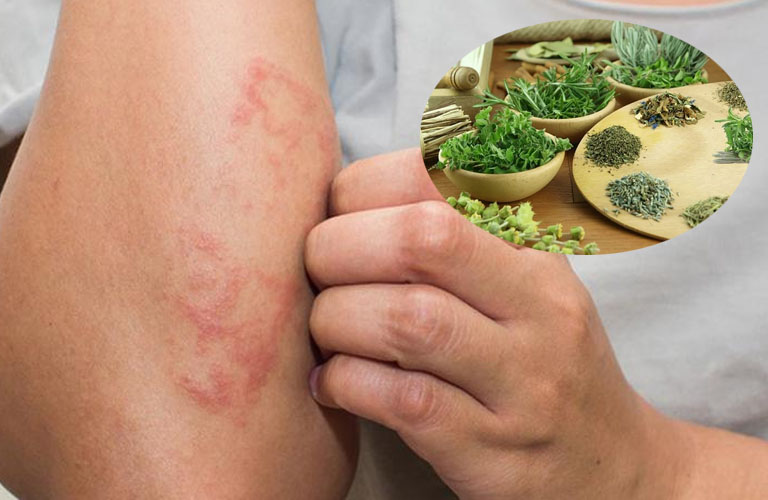 Chữa Eczema bằng thuốc Nam có hiệu quả nhưng phải kiên trì lâu dài