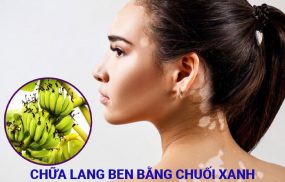 chữa lang ben bằng chuối xanh