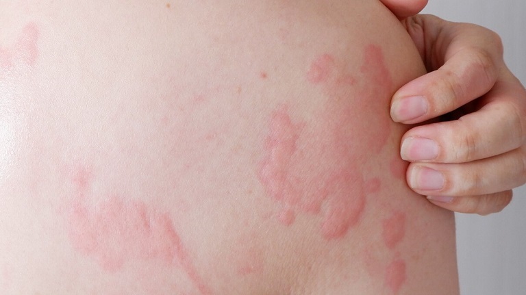 Da xuất hiện các mảng đỏ, sẩn phù hoặc phát ban không đều, gây nóng rát