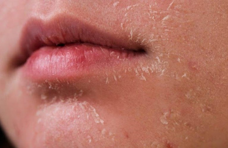 Da mặt khô tróc vảy là tình trạng bong các lớp da chết do da mất nước
