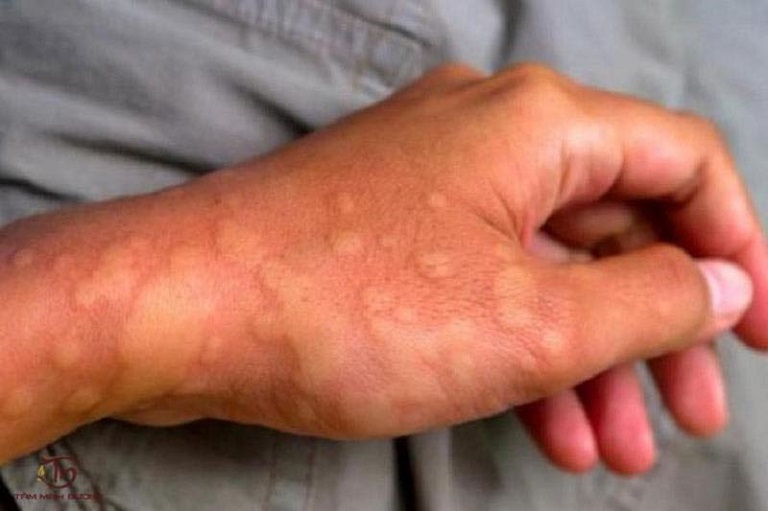Thay đổi nhiệt độ là nguyên nhân dẫn đến nổi mề đay