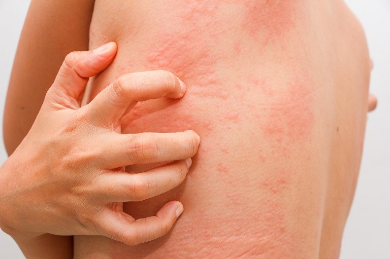 Hầu hết các trường hợp nổi mề đay khi giao mùa chỉ gây ngứa ngáy và khó chịu nhẹ và không nguy hiểm