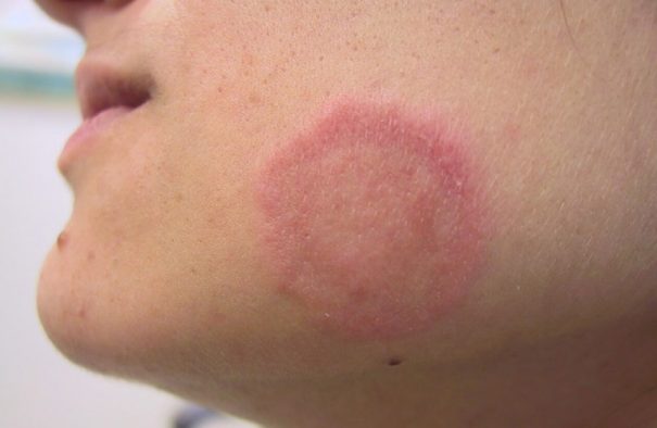 11 Cách Chữa Hắc Lào Bằng Phương Pháp Dân Gian Hiệu Quả, An Toàn